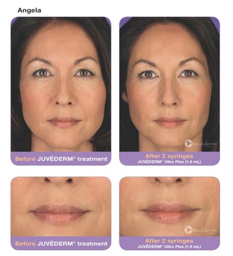 Juvederm Before And After Pictures Velvet Effect Lasers