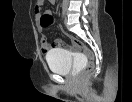 Vesicovaginal Fistula Radiology Reference Article Radiopaedia Org