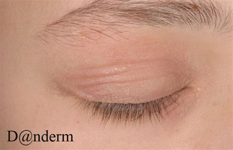2 108 55 Atopic Dermatitis Of The Eyelids 2 Of 2 Also In Large Size