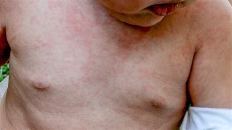 Viral Rash Types Symptoms And Treatment In Adults And Babies Images
