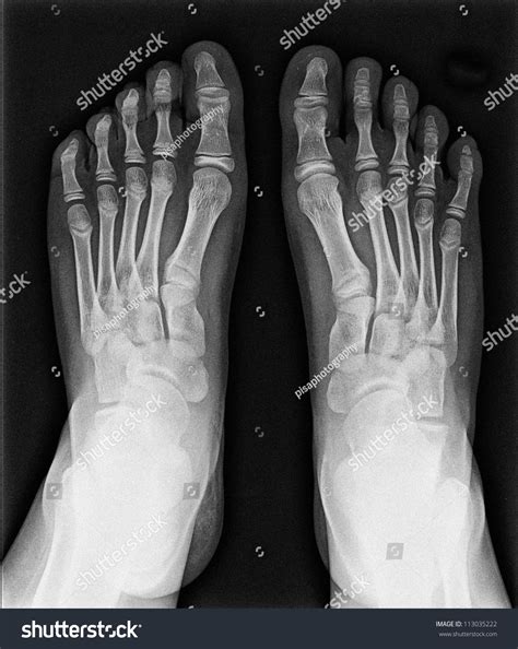 Mri Foot Fingers Exposed On Xray 스톡 사진 113035222 Shutterstock