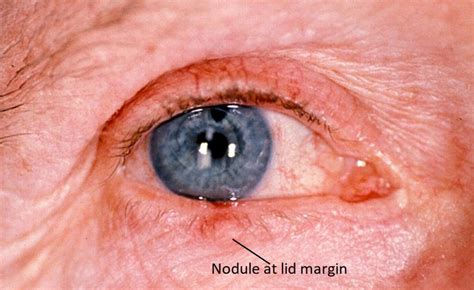 Moran Core Eyelids