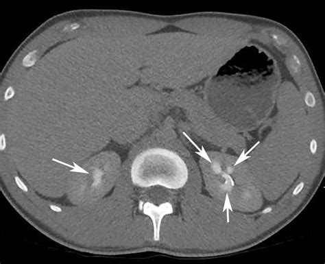 Papillary Blush An Axial Excretory Phase Contrast Enhanced Ct Image