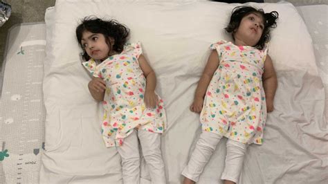 Conjoined Twins Return Home After Successful Separation Bbc News