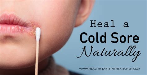 How To Heal A Cold Sore Naturally Cold Sore Cold Sores Remedies