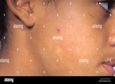 Pityriasis Alba Common Skin Condition Fotografías E Imágenes De Alta