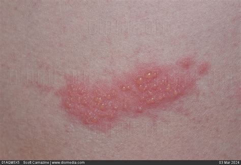 Stock Image A Shingles Herpes Zoster Virus Infection Which Has Causeda