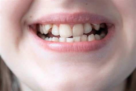 Signs That Your Child Needs Braces Eagle Harbor Dentist