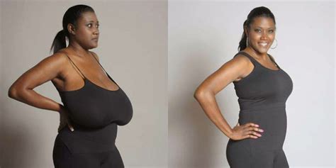 Woman With Breasts Weighing Kg Each Undergoes Surgery To Reduce Them