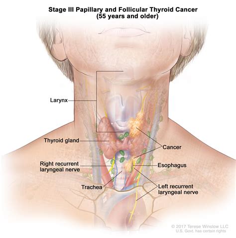 Your doctor will do a thorough physical exam. Thyroid Cancer Treatment (Adult) (PDQ®)-Patient Version ...