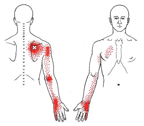 The shoulder muscles and shoulder tendons involved with shoulder mobility include the four rotator cuff muscle and tendon pairs: Serratus Posterior Superior | The Trigger Point & Referred Pain Guide | Health Myofascial ...