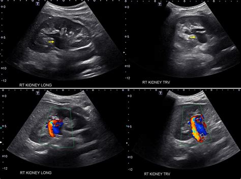The Ultrasound Mimics Of Hydronephrosis Renal Fellow Network