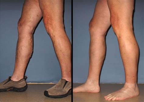 Before And After Vein Treatment Madison And Jackson Ms Vein Institute