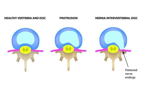 can a chiropractor fix a herniated disc oviedo chiropractic