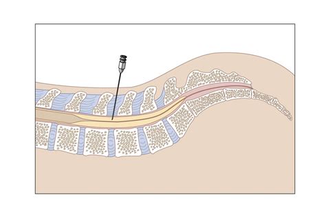 Lumbar Puncture Nhs