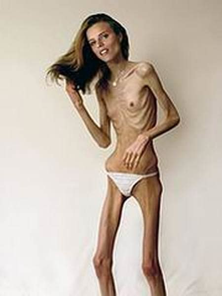 Anorexic Photo Album By Susanduva