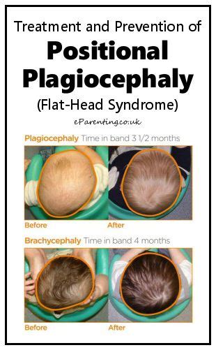 Positional Plagiocephaly Flat Head Syndrome