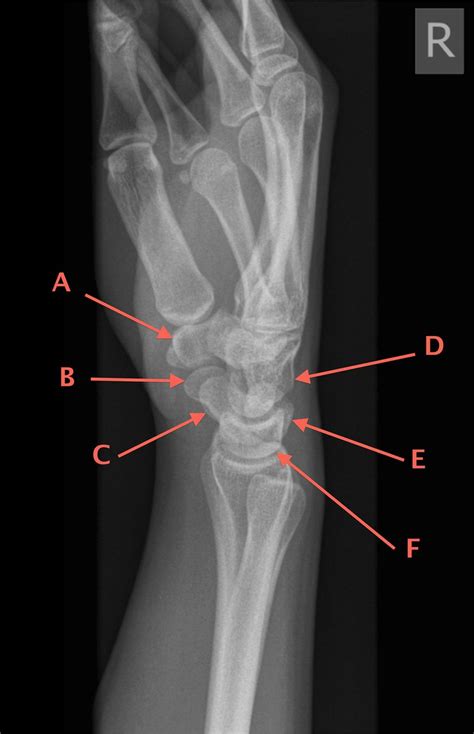 Lateral Wrist X Ray Anatomy