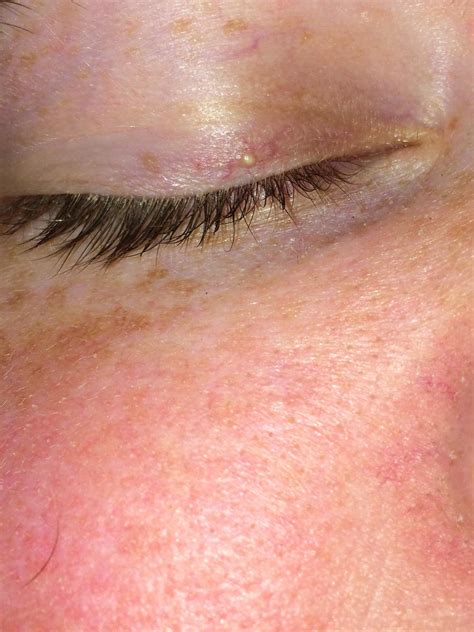 What Are The Causes For Tiny White Bumps On Your Eyelids