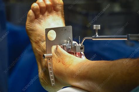 Total Ankle Replacement Surgery Stock Image C Science Photo Library