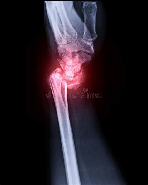 X Ray Image Of Left Wrist Joint Ap And Lateral View Stock Image Image