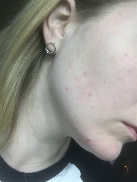 Skin Concerns Flat Red Spots On Cheeks Skincareaddiction