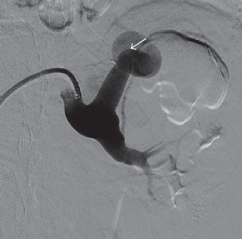 Figure From Intraparenchymal Renal Artery Pseudoaneurysm And