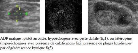 Echographie Dune Adénopathie Cervicale