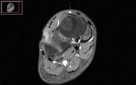 Ruptured Ganglion Cyst Of The Foot Mri Findings Eurorad