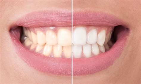 Do Teeth Whitening Kits You Use At Home Really Work Health