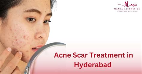 Acne Scar Treatment Guide Get Back Your Skin Confidence Again