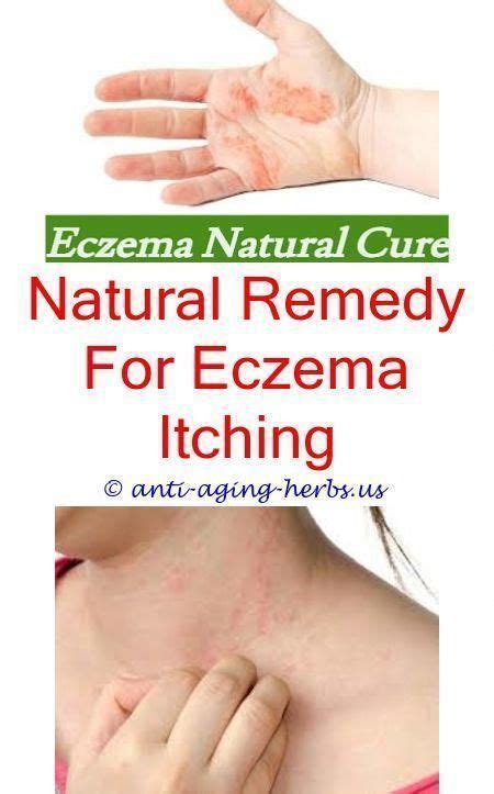Baby Covered In Eczemahow To Ease Eczemaeczema Cleared Up With