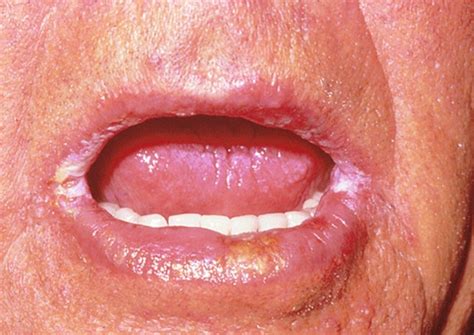 Angular Cheilitis What Is It Causes Treatment And Mor