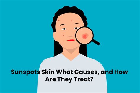 Sunspots Sunspots Skin Causes Treatment And More