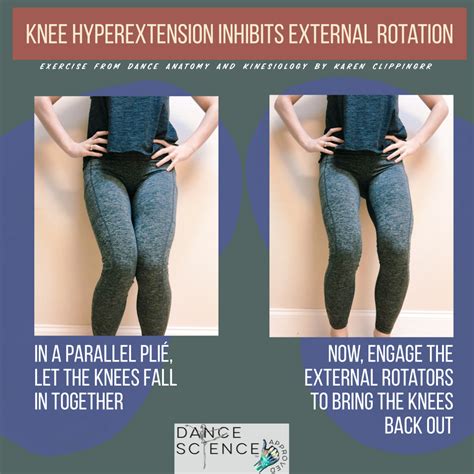 Hyperextended Knee Exercises The Hyperextension Dilemma Cirque Physio