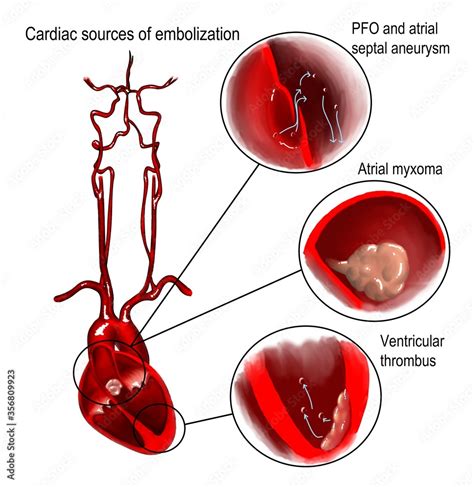 The Different Courses Of Cardioembolism Leading To Ischemic Stroke And