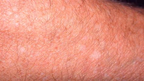 Small White Spots On Skin