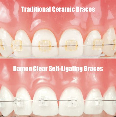 Damon Clear Self Ligating Braces Baker Street Dental