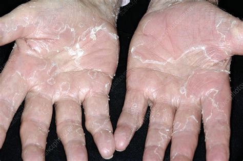 Peeling Skin On Hands From Stress Stock Image C0042410 Science