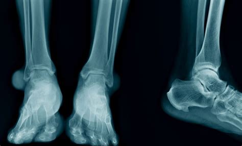 Ankle Arthritis Swelling And Pain Treatment Doctor Moore Foot And Ankle