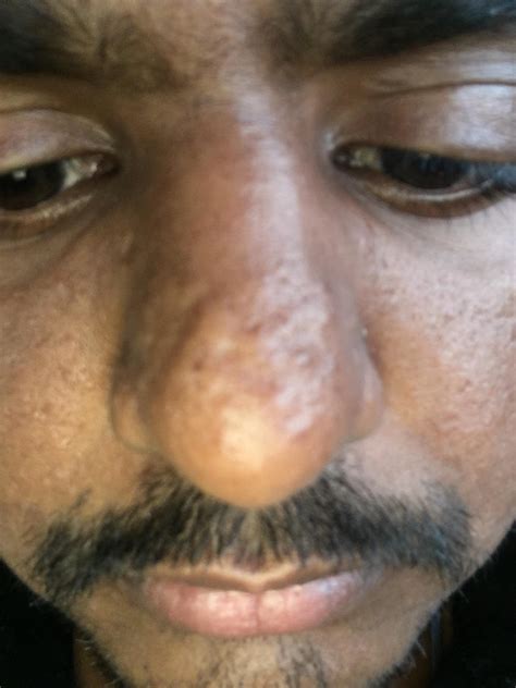 Small Bumps On Nose
