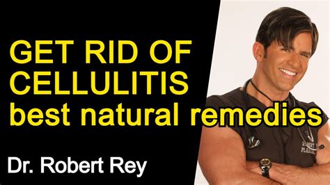 Get Rid Of Cellulitis Best Home Remedies Dr Rey Youtube