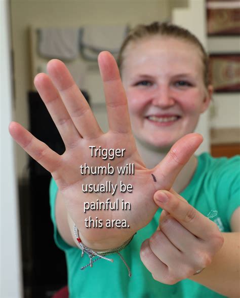Trigger Finger Or Trigger Thumb Otherwise Known As Stenosing