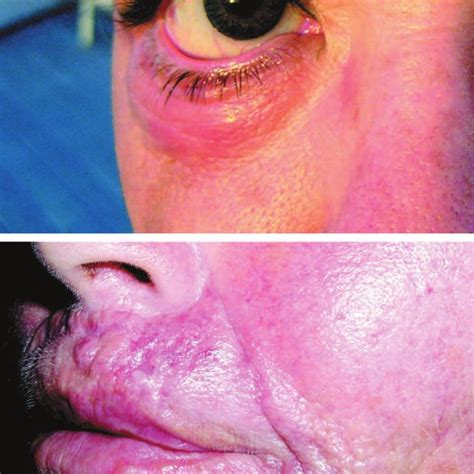 Above Particulate Fillers Artecoll Can Cause Sclerosing Granulomas