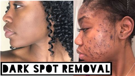 Skin How To Get Rid Of Dark Scars Hyperpigmentation And Acne Scars At
