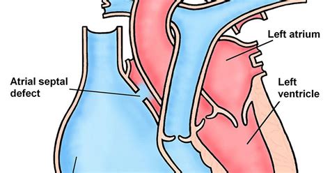 Congenital anomaly (birth defect), a disorder present at birth. medicare: Ebstein Anomaly