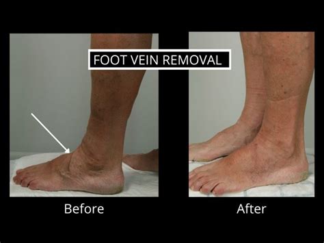 Varicose Veins In Feet The Veincare Centre