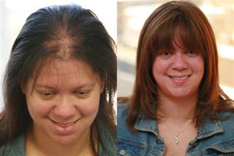 Hgh For Hair Loss Before And After Pics Can You Get Hair Back With Hgh