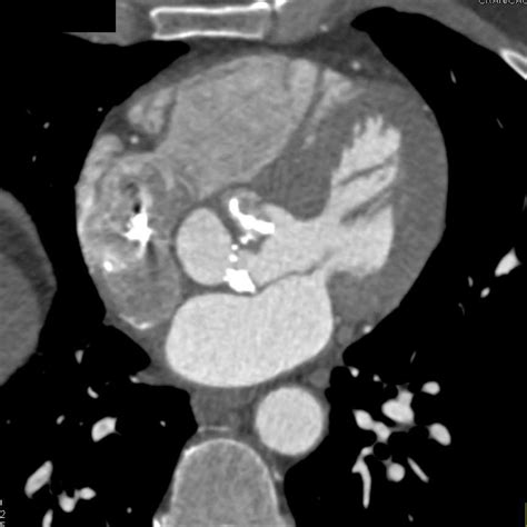 Aortic Valvular Calcification With Aortic Stenosis And Dilated
