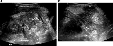 Paediatric Bowel Ultrasound In Inflammatory Bowel Disease European Journal Of Radiology